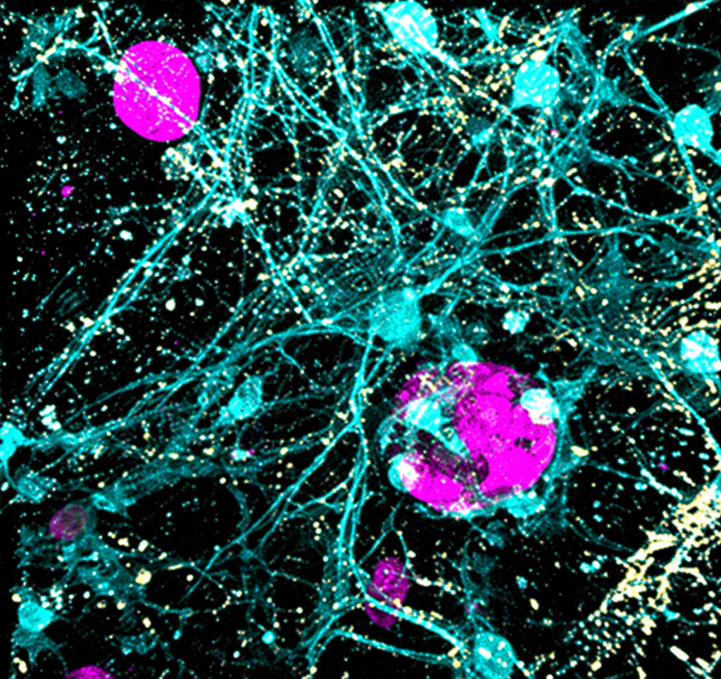 AI-upscaled fluorescence image from a 3D brain-metastasis model showing GluA2 in cyan, tumor cells in magenta and vGluT1 in yellow